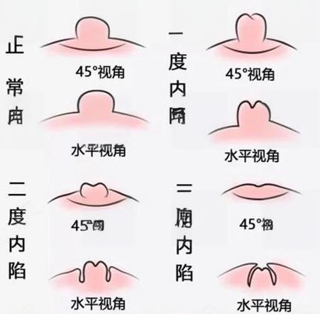 为什么乳头会硬