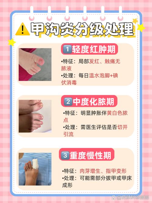 甲沟炎什么科室