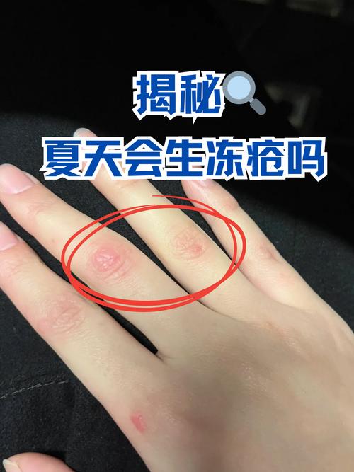 为什么冻疮会痒