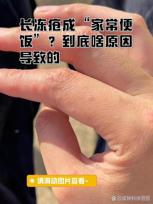 为什么冻疮会痒