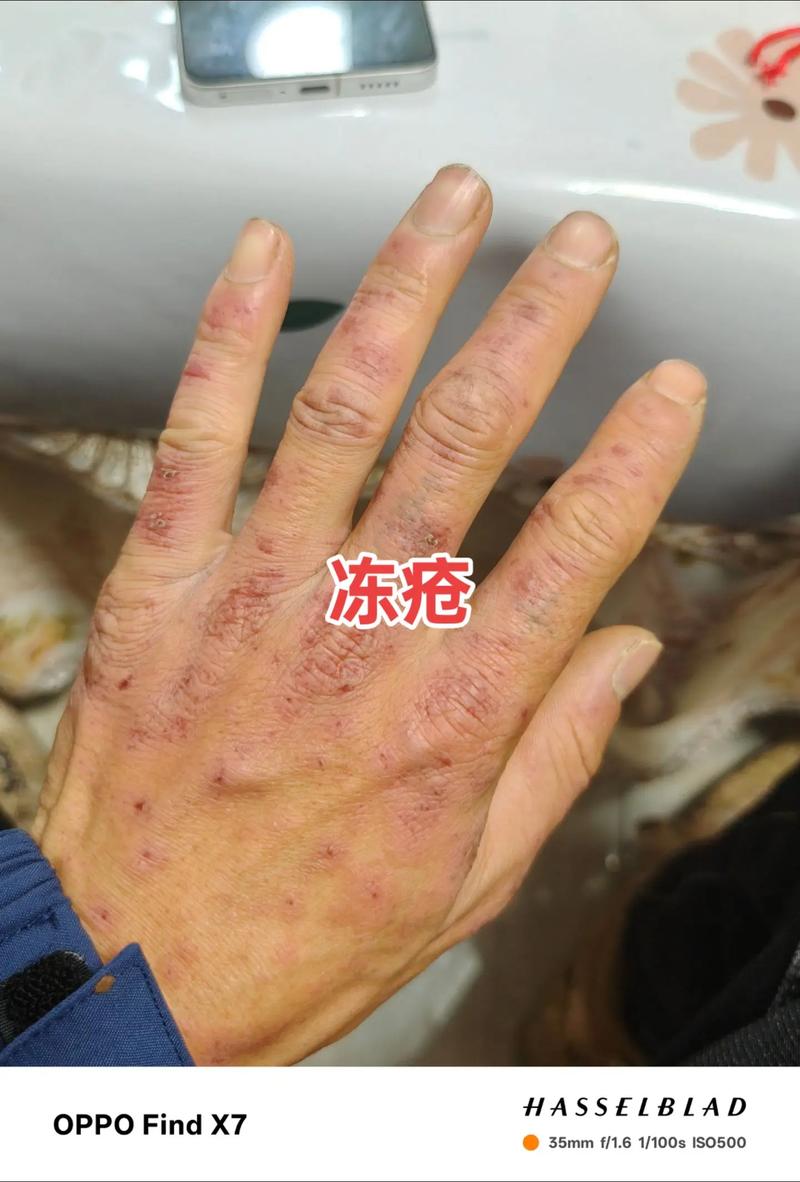 为什么冻疮会痒