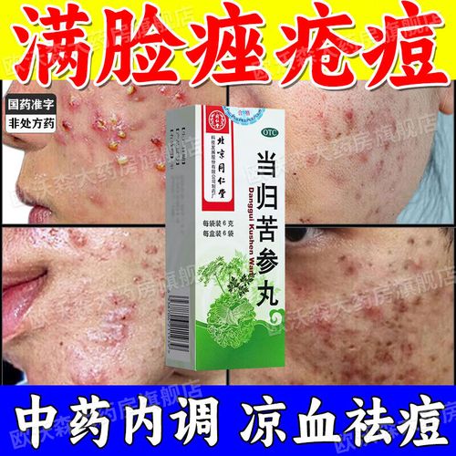 长粉刺吃什么药