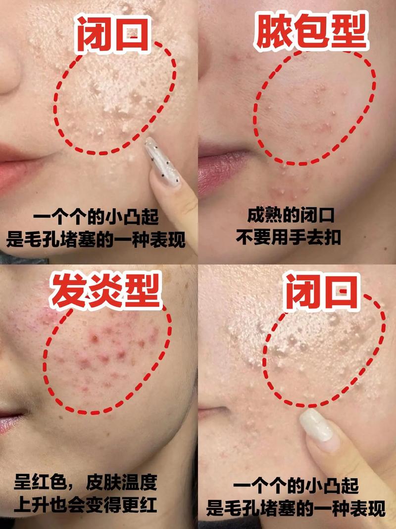 洗面奶会导致闭口吗