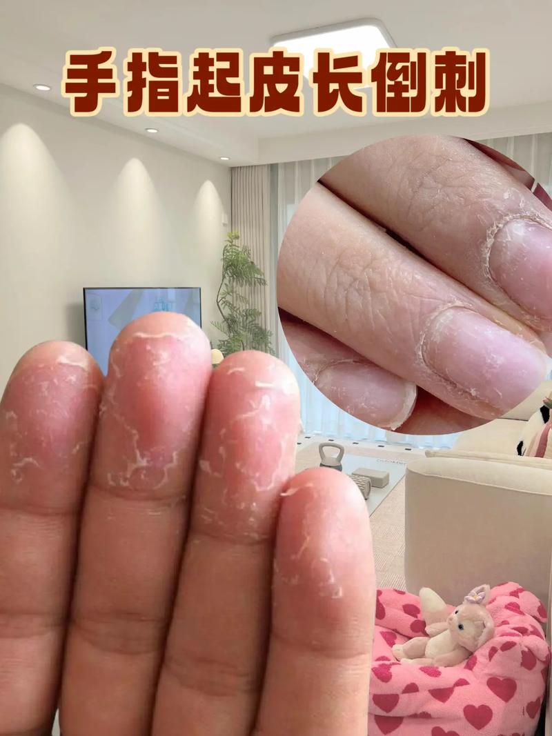 手指头脱皮什么原因
