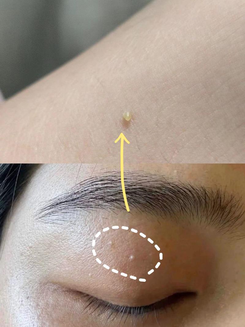 脂肪粒什么样子