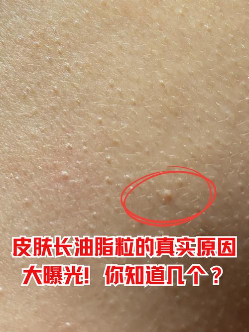 脂肪粒什么样子