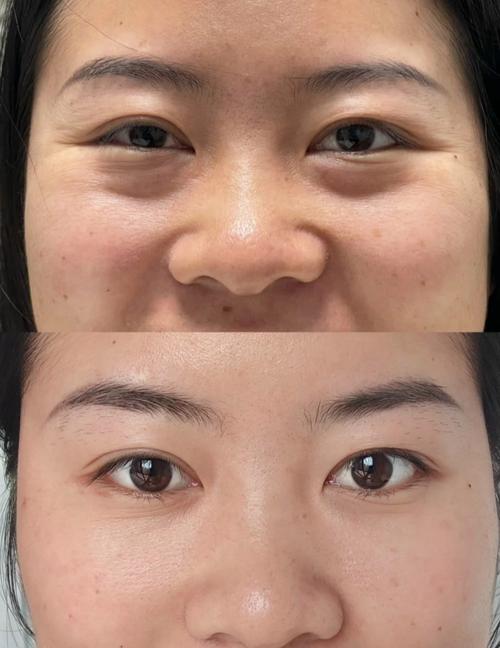 眼袋是什么样子