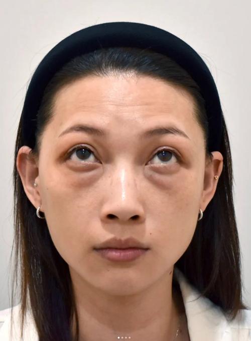 眼袋是什么样子