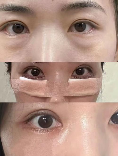 眼袋是什么样子