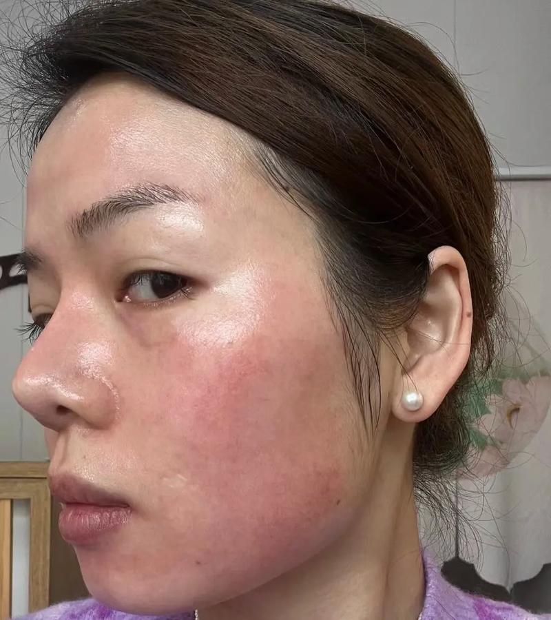 脸部过敏涂什么