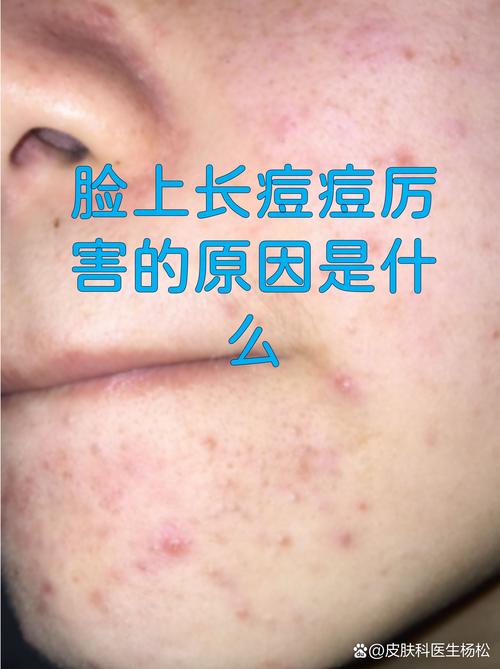 长痘是什么肤质