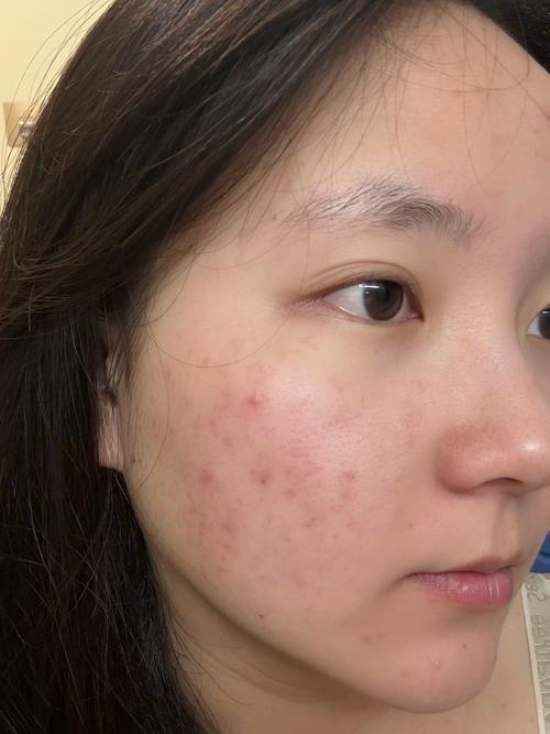 长痘是什么肤质