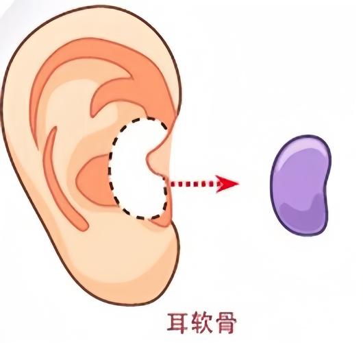 耳软骨是什么