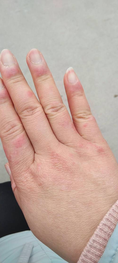 冻疮为什么会痒