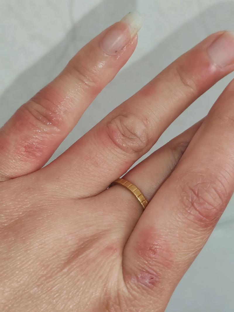 冻疮为什么会痒