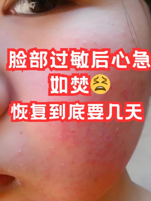 为何用洗面奶就过敏