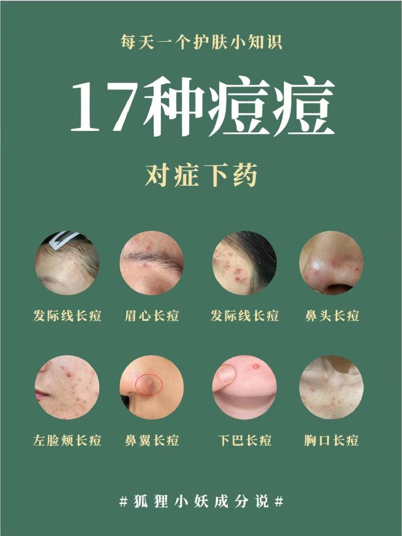 为什么鼻子长痘