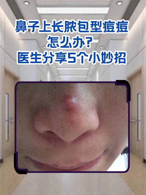 为什么鼻子长痘