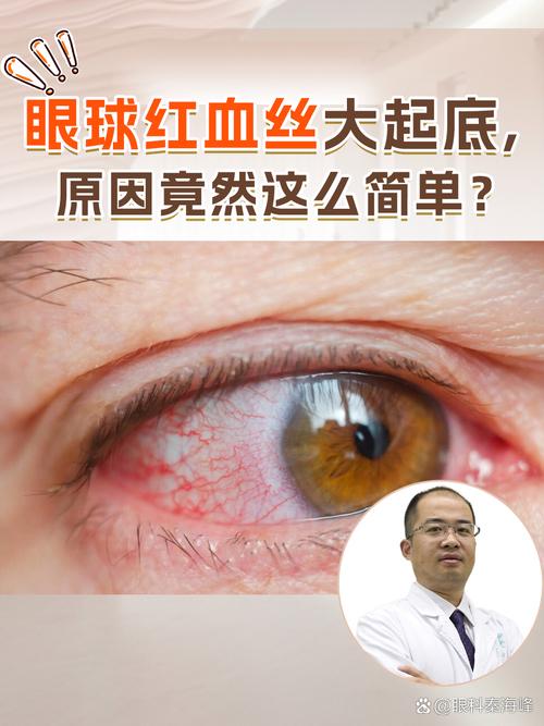 眼睛红血丝什么原因