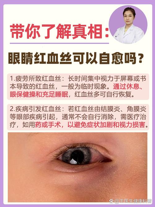 眼睛红血丝什么原因