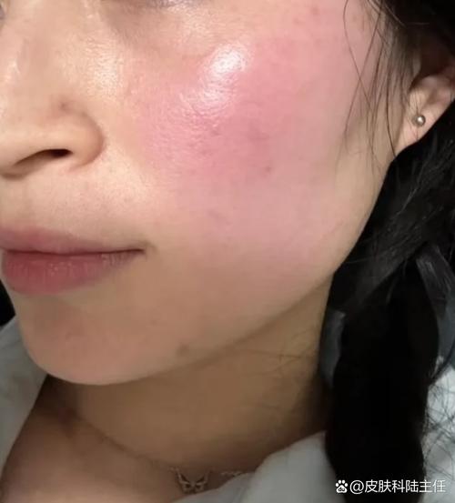 脸过敏了能擦护肤品吗