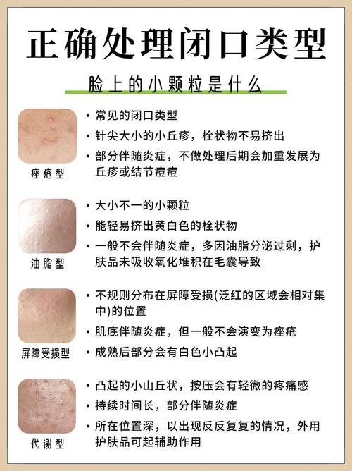 为什么长闭口粉刺