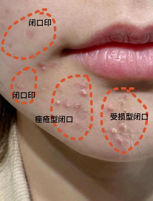 为什么长闭口粉刺