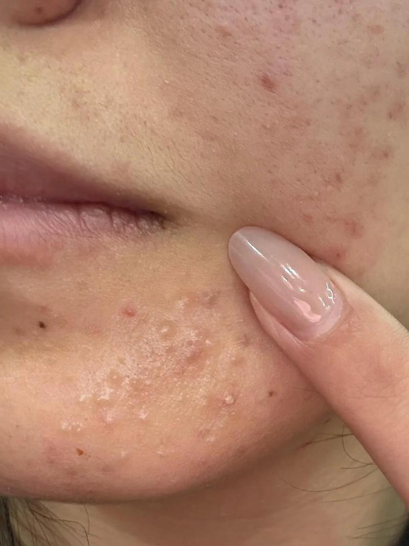 为什么长闭口粉刺