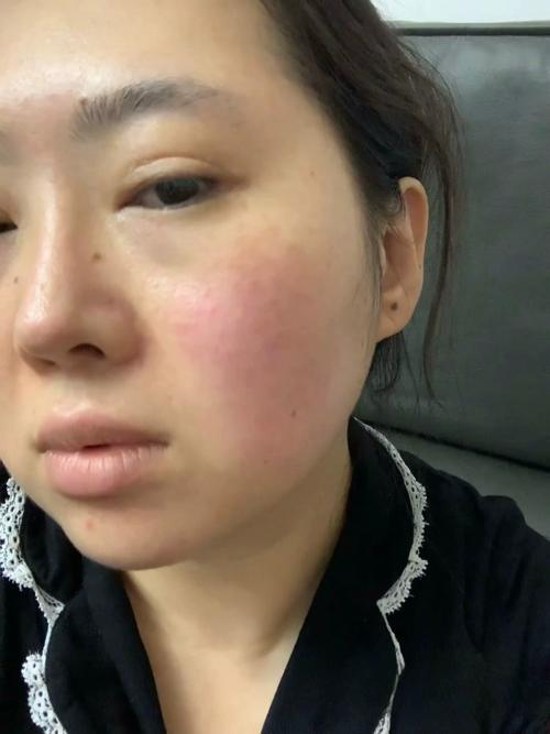 用洗面奶后发红疼痛