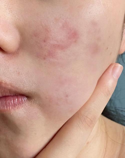 用洗面奶后发红疼痛