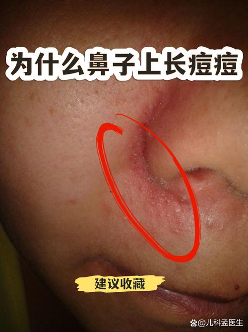 鼻子长痘为什么