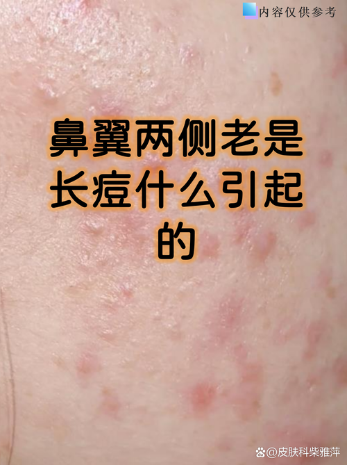 鼻子长痘为什么