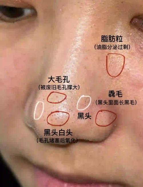 用什么去黑头最好