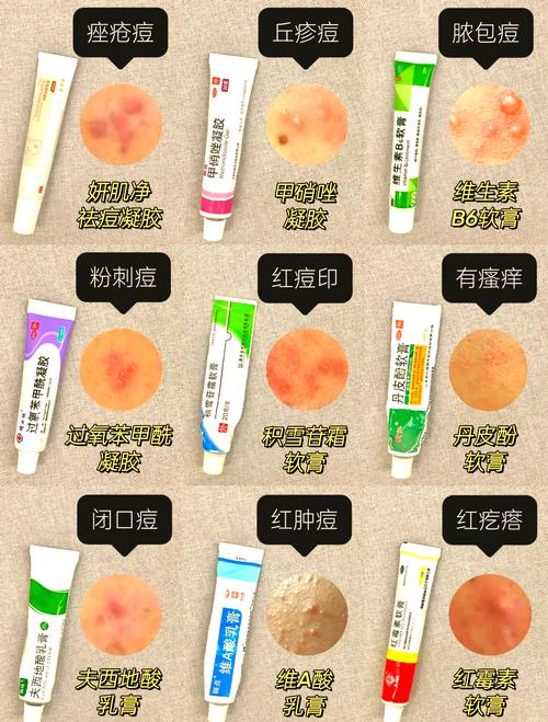 适合油性痘痘的护肤品