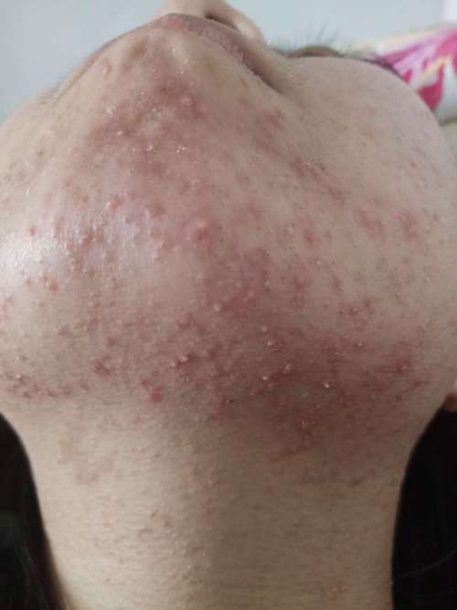 痤疮是什么样的