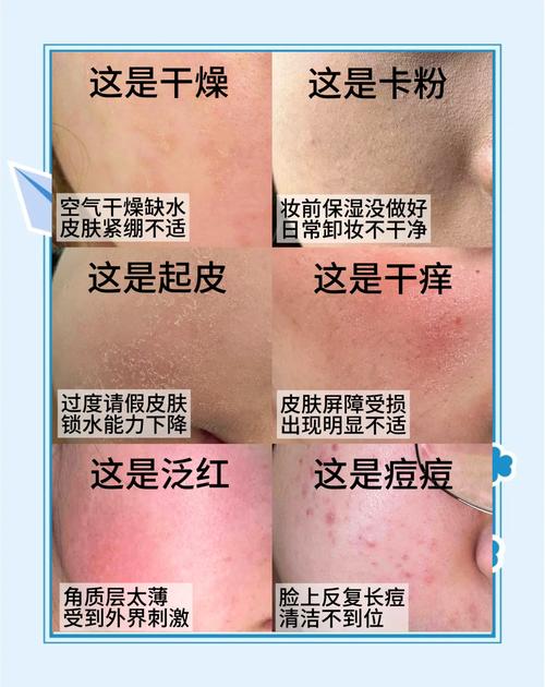 护肤品用过敏了怎么办