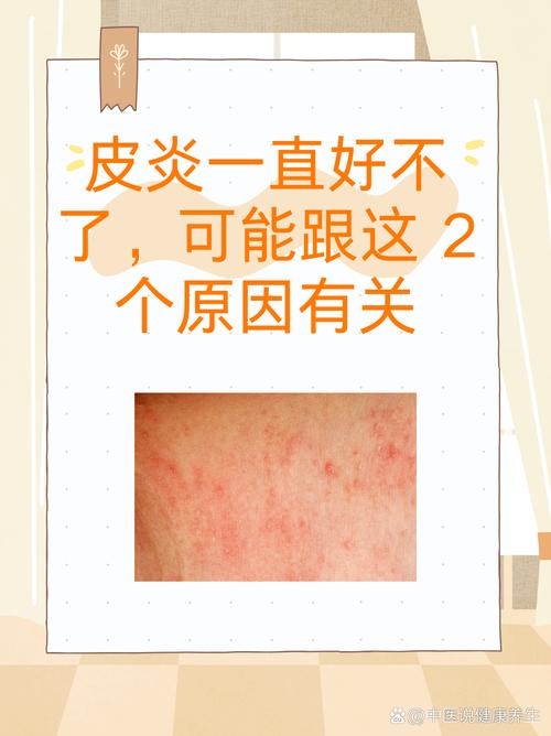 皮肤过敏还擦护肤品吗