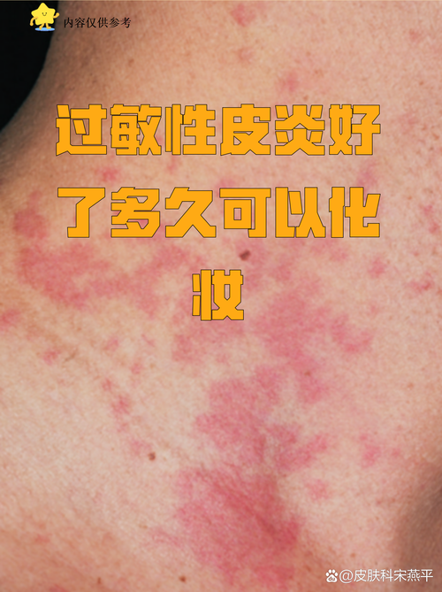 皮肤过敏还擦护肤品吗