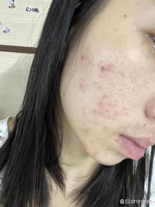 什么洗面奶会长痘痘