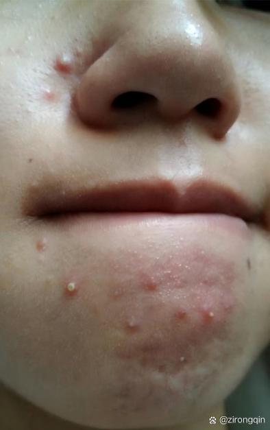 什么洗面奶会长痘痘