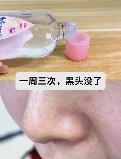 猪鼻子洗面奶去黑头