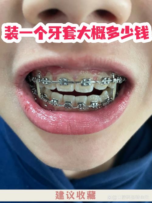 什么样的牙套好