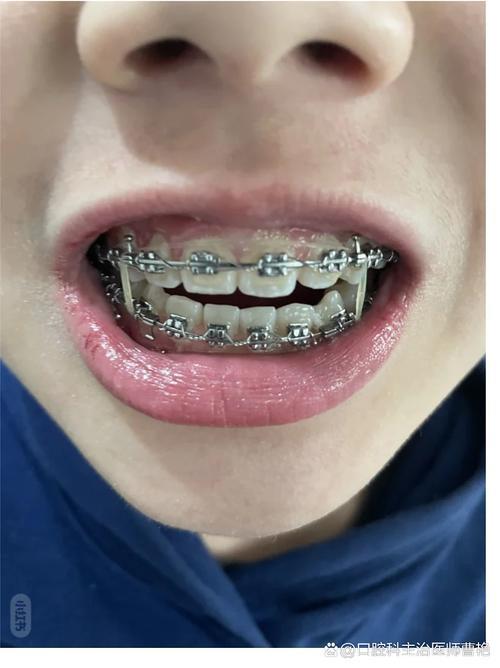 什么样的牙套好