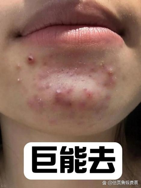 粉刺能用洗面奶洗吗