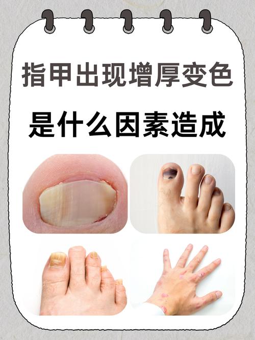 为什么手指发黄