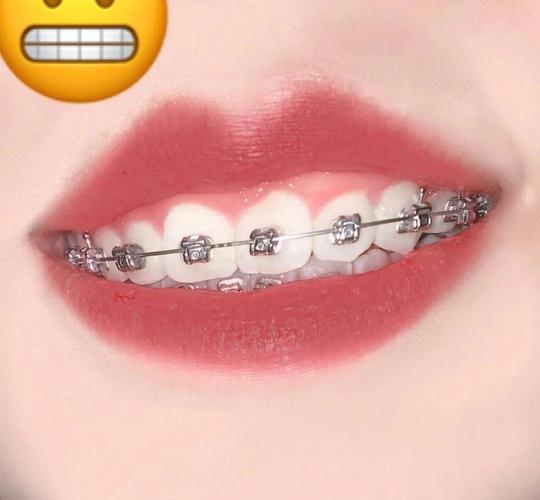 牙套什么样的好