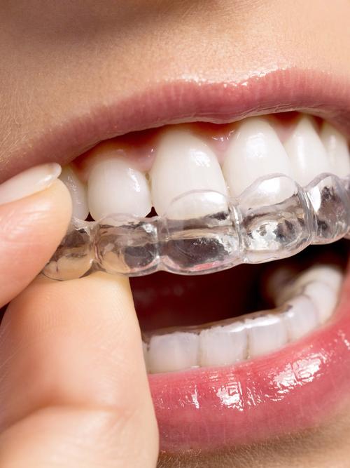 牙套什么样的好