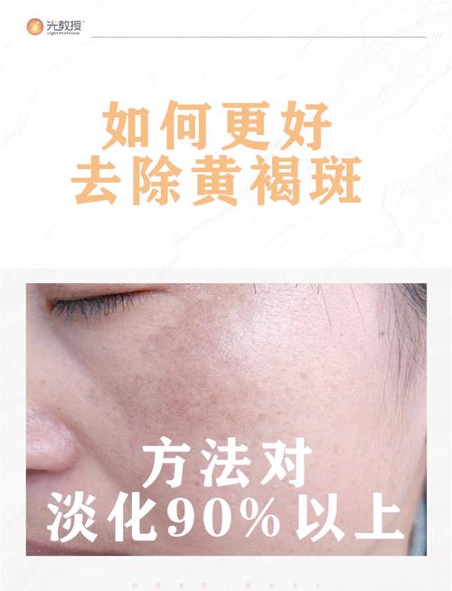 什么方法祛斑好