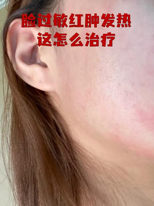 脸过敏是什么原因