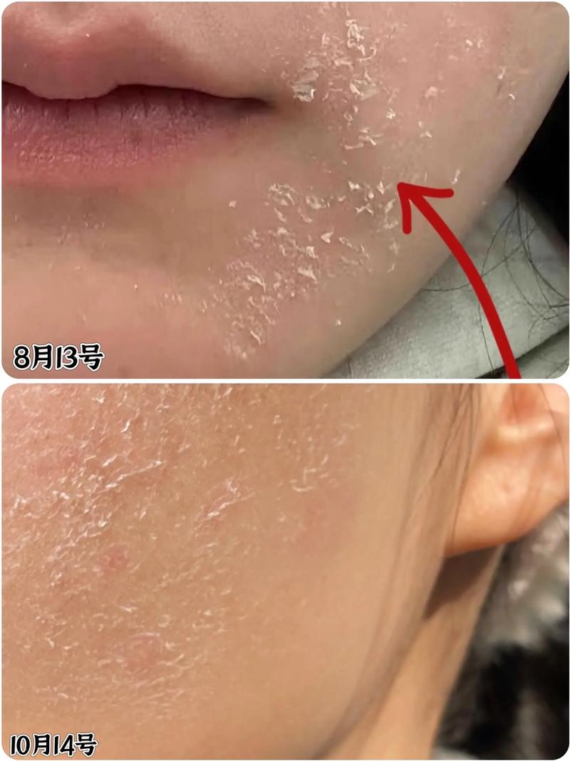雅漾洗面奶用完脱皮